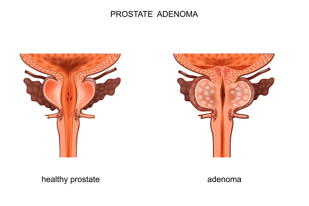 gesunde Prostata und mit Adenomen